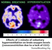 Overbreathing Is Found In Over 95% of People